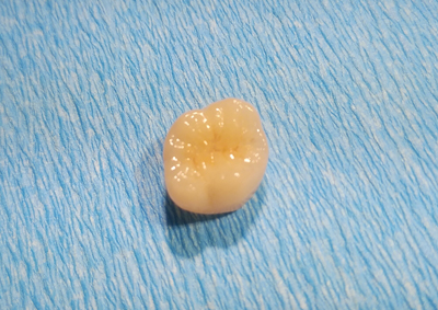 オールセラミクス